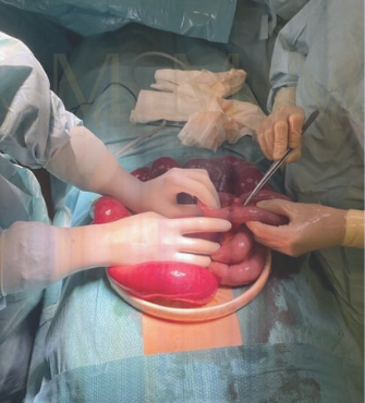 Obstrucción intestinal por brida