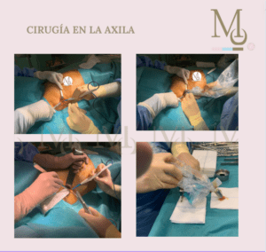 Resumen en imágenes de la cirugía que se realiza para la biopsia selectiva de ganglio centinela.