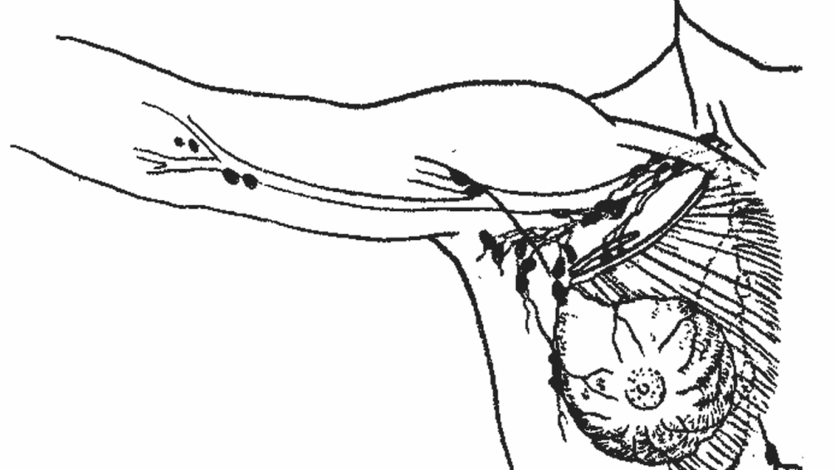 Importancia del sistema linfoide  en el cáncer de mama
